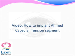 Video: How to implant Ahmed
Capsular Tension segment
 