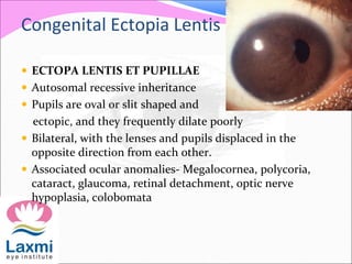 Congenital Ectopia Lentis
 ECTOPA LENTIS ET PUPILLAE
 Autosomal recessive inheritance
 Pupils are oval or slit shaped and
ectopic, and they frequently dilate poorly
 Bilateral, with the lenses and pupils displaced in the
opposite direction from each other.
 Associated ocular anomalies- Megalocornea, polycoria,
cataract, glaucoma, retinal detachment, optic nerve
hypoplasia, colobomata
 