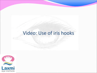 Video: Use of iris hooks
 