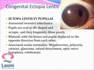 Congenital Ectopia Lentis
 ECTOPA LENTIS ET PUPILLAE
 Autosomal recessive inheritance
 Pupils are oval or slit shaped a...