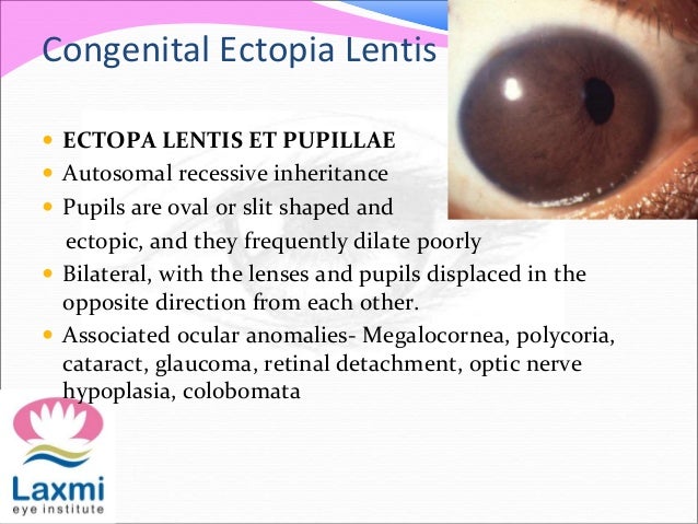 ectopic pupil
