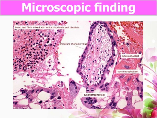 Ectopic pregnancy PBL