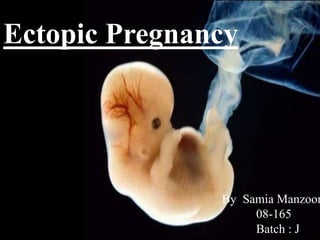 Ectopic Pregnancy
By Samia Manzoor
08-165
Batch : J
 