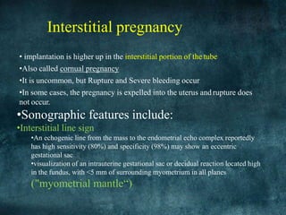 ectopic-.pptx