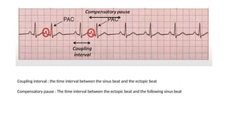 artrial and ventricular ectopic ecg teaching | PPTX