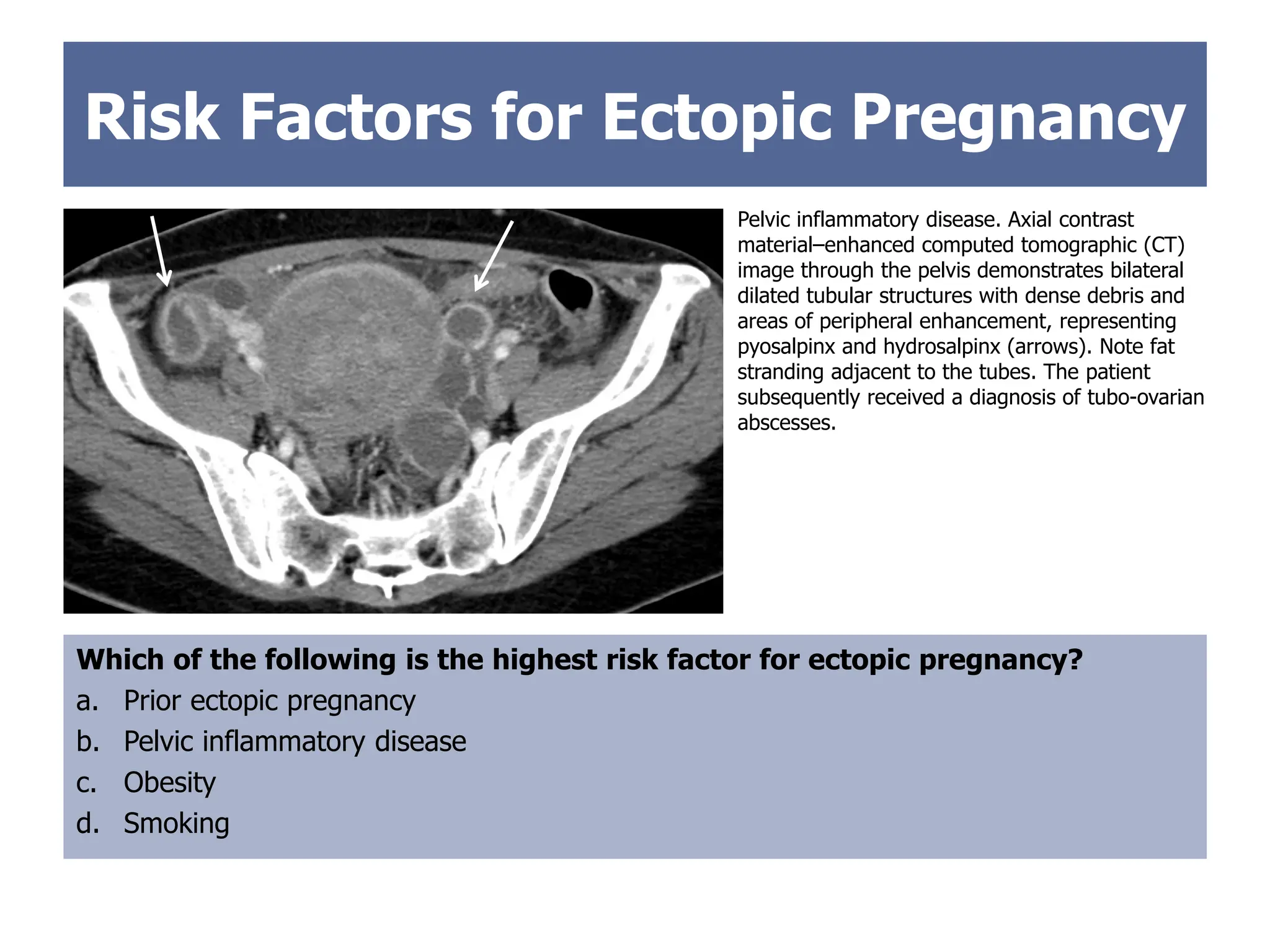 Risk Factors for Ectopic Pregnancy
Which of the following is the highest risk factor for ectopic pregnancy?
a. Prior ectopic pregnancy
b. Pelvic inflammatory disease
c. Obesity
d. Smoking
Pelvic inflammatory disease. Axial contrast
material–enhanced computed tomographic (CT)
image through the pelvis demonstrates bilateral
dilated tubular structures with dense debris and
areas of peripheral enhancement, representing
pyosalpinx and hydrosalpinx (arrows). Note fat
stranding adjacent to the tubes. The patient
subsequently received a diagnosis of tubo-ovarian
abscesses.
 