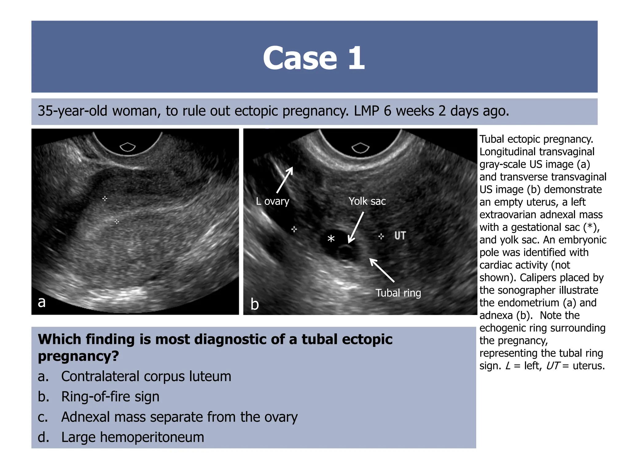 Case 1
35-year-old woman, to rule out ectopic pregnancy. LMP 6 weeks 2 days ago.
Tubal ectopic pregnancy.
Longitudinal transvaginal
gray-scale US image (a)
and transverse transvaginal
US image (b) demonstrate
an empty uterus, a left
extraovarian adnexal mass
with a gestational sac (*),
and yolk sac. An embryonic
pole was identified with
cardiac activity (not
shown). Calipers placed by
the sonographer illustrate
the endometrium (a) and
adnexa (b). Note the
echogenic ring surrounding
the pregnancy,
representing the tubal ring
sign. L = left, UT = uterus.
Which finding is most diagnostic of a tubal ectopic
pregnancy?
a. Contralateral corpus luteum
b. Ring-of-fire sign
c. Adnexal mass separate from the ovary
d. Large hemoperitoneum
a b
*
L ovary Yolk sac
Tubal ring
 