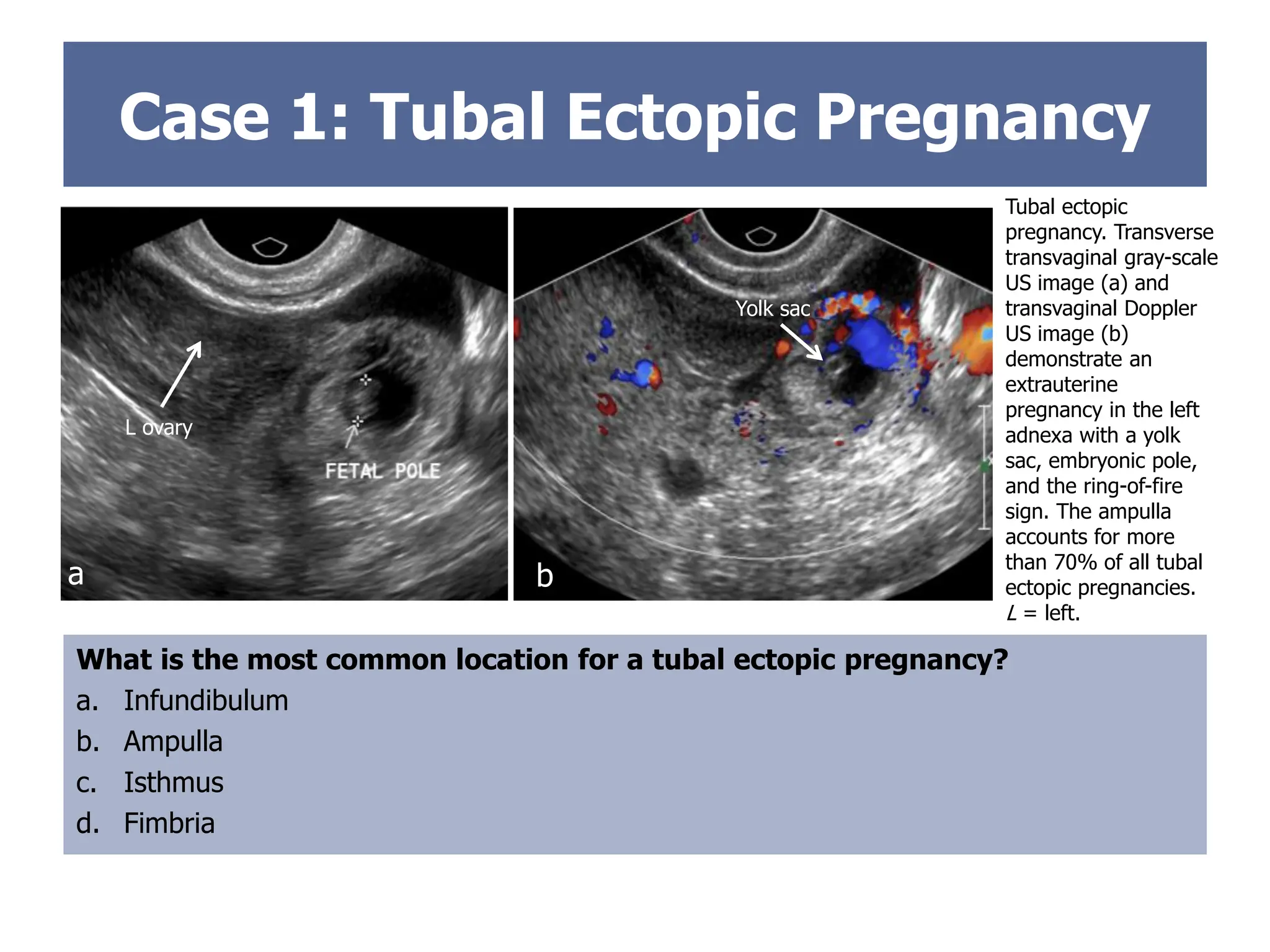 Case 1: Tubal Ectopic Pregnancy
Tubal ectopic
pregnancy. Transverse
transvaginal gray-scale
US image (a) and
transvaginal Doppler
US image (b)
demonstrate an
extrauterine
pregnancy in the left
adnexa with a yolk
sac, embryonic pole,
and the ring-of-fire
sign. The ampulla
accounts for more
than 70% of all tubal
ectopic pregnancies.
L = left.
What is the most common location for a tubal ectopic pregnancy?
a. Infundibulum
b. Ampulla
c. Isthmus
d. Fimbria
RING OF FIRE
b
a
L ovary
Yolk sac
 