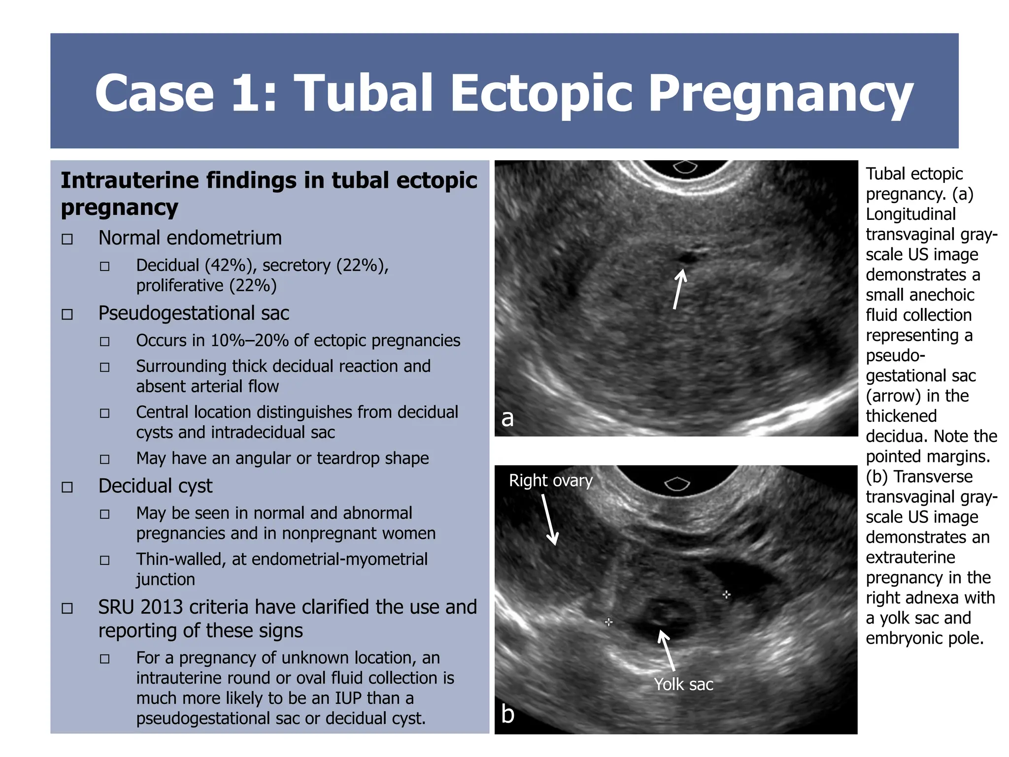 Right ovary
Case 1: Tubal Ectopic Pregnancy
Intrauterine findings in tubal ectopic
pregnancy
 Normal endometrium
 Decidual (42%), secretory (22%),
proliferative (22%)
 Pseudogestational sac
 Occurs in 10%–20% of ectopic pregnancies
 Surrounding thick decidual reaction and
absent arterial flow
 Central location distinguishes from decidual
cysts and intradecidual sac
 May have an angular or teardrop shape
 Decidual cyst
 May be seen in normal and abnormal
pregnancies and in nonpregnant women
 Thin-walled, at endometrial-myometrial
junction
 SRU 2013 criteria have clarified the use and
reporting of these signs
 For a pregnancy of unknown location, an
intrauterine round or oval fluid collection is
much more likely to be an IUP than a
pseudogestational sac or decidual cyst.
Tubal ectopic
pregnancy. (a)
Longitudinal
transvaginal gray-
scale US image
demonstrates a
small anechoic
fluid collection
representing a
pseudo-
gestational sac
(arrow) in the
thickened
decidua. Note the
pointed margins.
(b) Transverse
transvaginal gray-
scale US image
demonstrates an
extrauterine
pregnancy in the
right adnexa with
a yolk sac and
embryonic pole.
a
b
Yolk sac
 