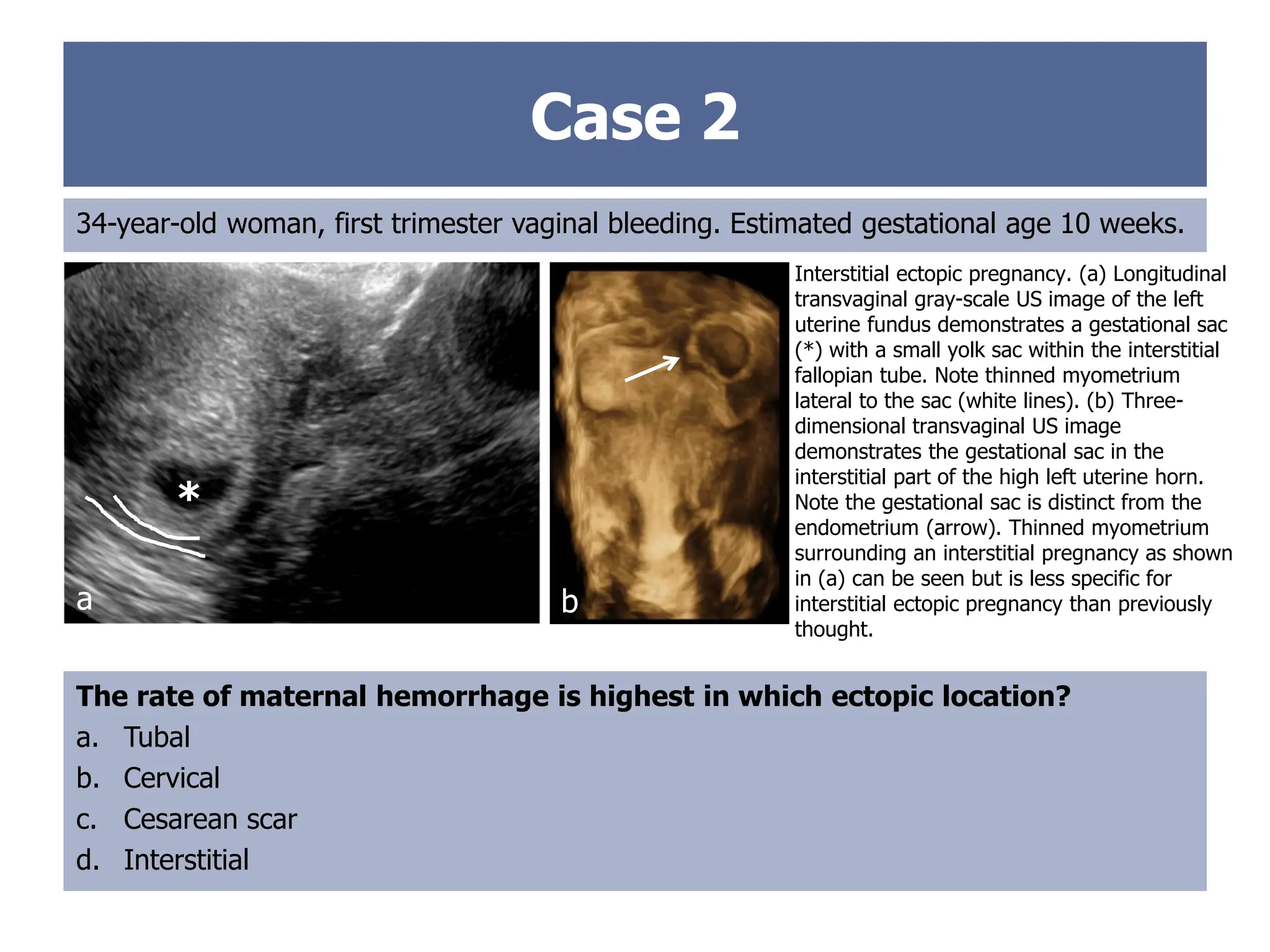 Case 2
34-year-old woman, first trimester vaginal bleeding. Estimated gestational age 10 weeks.
The rate of maternal hemorrhage is highest in which ectopic location?
a. Tubal
b. Cervical
c. Cesarean scar
d. Interstitial
Interstitial ectopic pregnancy. (a) Longitudinal
transvaginal gray-scale US image of the left
uterine fundus demonstrates a gestational sac
(*) with a small yolk sac within the interstitial
fallopian tube. Note thinned myometrium
lateral to the sac (white lines). (b) Three-
dimensional transvaginal US image
demonstrates the gestational sac in the
interstitial part of the high left uterine horn.
Note the gestational sac is distinct from the
endometrium (arrow). Thinned myometrium
surrounding an interstitial pregnancy as shown
in (a) can be seen but is less specific for
interstitial ectopic pregnancy than previously
thought.
*
a b
 