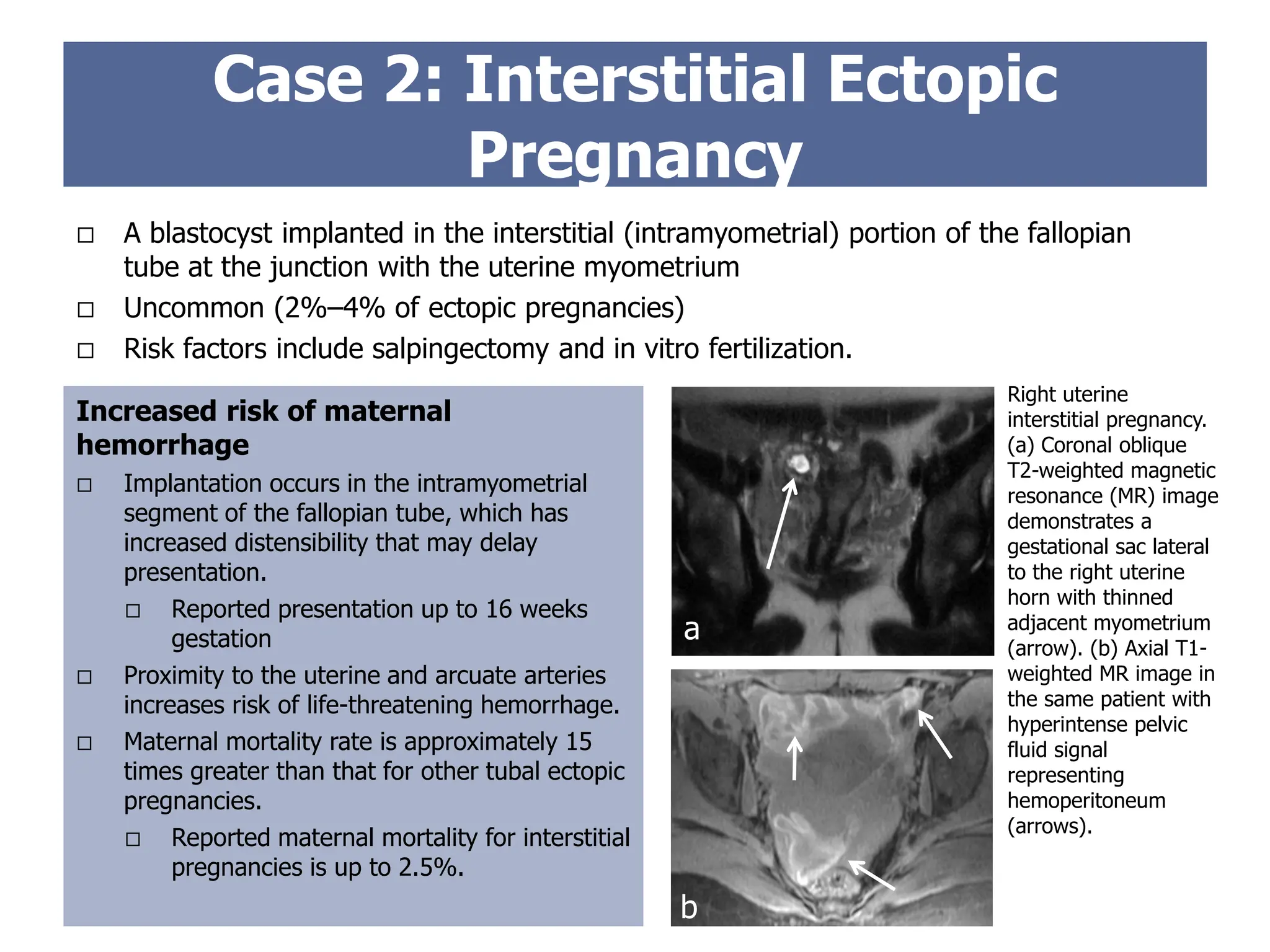 Case 2: Interstitial Ectopic
Pregnancy
Increased risk of maternal
hemorrhage
 Implantation occurs in the intramyometrial
segment of the fallopian tube, which has
increased distensibility that may delay
presentation.
 Reported presentation up to 16 weeks
gestation
 Proximity to the uterine and arcuate arteries
increases risk of life-threatening hemorrhage.
 Maternal mortality rate is approximately 15
times greater than that for other tubal ectopic
pregnancies.
 Reported maternal mortality for interstitial
pregnancies is up to 2.5%.
 A blastocyst implanted in the interstitial (intramyometrial) portion of the fallopian
tube at the junction with the uterine myometrium
 Uncommon (2%–4% of ectopic pregnancies)
 Risk factors include salpingectomy and in vitro fertilization.
Right uterine
interstitial pregnancy.
(a) Coronal oblique
T2-weighted magnetic
resonance (MR) image
demonstrates a
gestational sac lateral
to the right uterine
horn with thinned
adjacent myometrium
(arrow). (b) Axial T1-
weighted MR image in
the same patient with
hyperintense pelvic
fluid signal
representing
hemoperitoneum
(arrows).
a
b
 