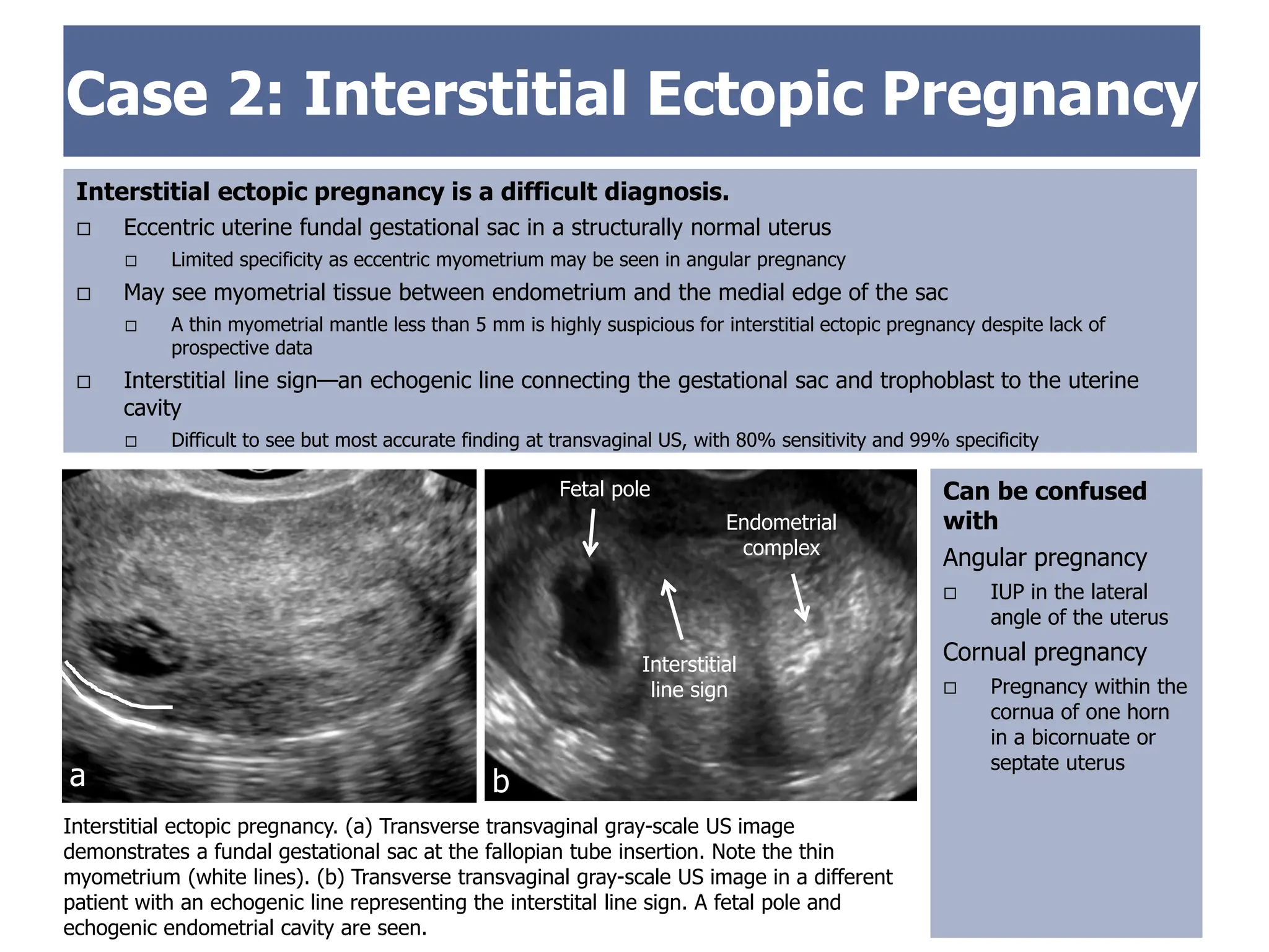 Case 2: Interstitial Ectopic Pregnancy
Interstitial ectopic pregnancy is a difficult diagnosis.
 Eccentric uterine fundal gestational sac in a structurally normal uterus
 Limited specificity as eccentric myometrium may be seen in angular pregnancy
 May see myometrial tissue between endometrium and the medial edge of the sac
 A thin myometrial mantle less than 5 mm is highly suspicious for interstitial ectopic pregnancy despite lack of
prospective data
 Interstitial line sign—an echogenic line connecting the gestational sac and trophoblast to the uterine
cavity
 Difficult to see but most accurate finding at transvaginal US, with 80% sensitivity and 99% specificity
Interstitial ectopic pregnancy. (a) Transverse transvaginal gray-scale US image
demonstrates a fundal gestational sac at the fallopian tube insertion. Note the thin
myometrium (white lines). (b) Transverse transvaginal gray-scale US image in a different
patient with an echogenic line representing the interstital line sign. A fetal pole and
echogenic endometrial cavity are seen.
Endometrial
complex
Interstitial
line sign
a b
Fetal pole Can be confused
with
Angular pregnancy
 IUP in the lateral
angle of the uterus
Cornual pregnancy
 Pregnancy within the
cornua of one horn
in a bicornuate or
septate uterus
 