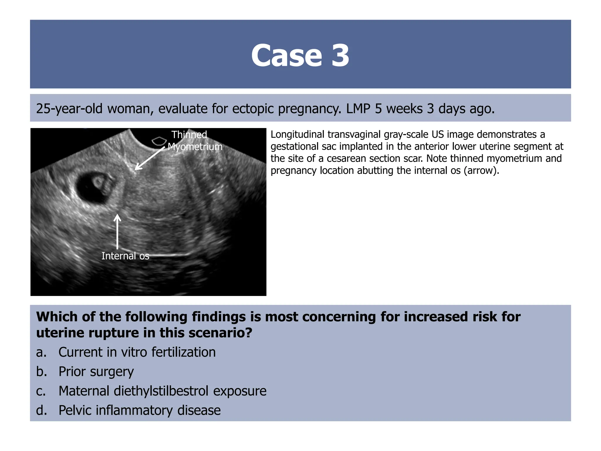 Case 3
25-year-old woman, evaluate for ectopic pregnancy. LMP 5 weeks 3 days ago.
Which of the following findings is most concerning for increased risk for
uterine rupture in this scenario?
a. Current in vitro fertilization
b. Prior surgery
c. Maternal diethylstilbestrol exposure
d. Pelvic inflammatory disease
Longitudinal transvaginal gray-scale US image demonstrates a
gestational sac implanted in the anterior lower uterine segment at
the site of a cesarean section scar. Note thinned myometrium and
pregnancy location abutting the internal os (arrow).
Internal os
Thinned
Myometrium
 