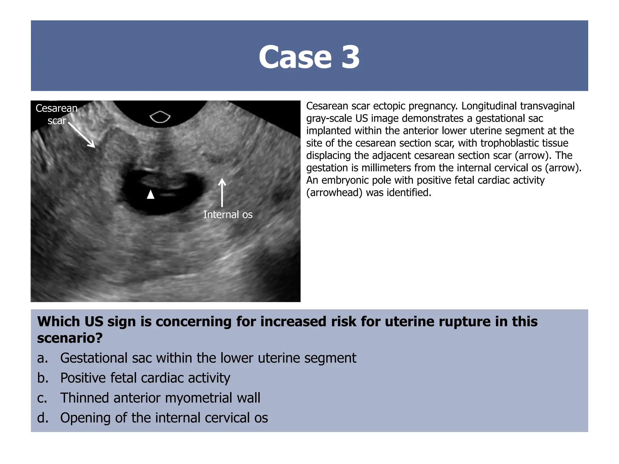 Case 3
Cesarean scar ectopic pregnancy. Longitudinal transvaginal
gray-scale US image demonstrates a gestational sac
implanted within the anterior lower uterine segment at the
site of the cesarean section scar, with trophoblastic tissue
displacing the adjacent cesarean section scar (arrow). The
gestation is millimeters from the internal cervical os (arrow).
An embryonic pole with positive fetal cardiac activity
(arrowhead) was identified.
Which US sign is concerning for increased risk for uterine rupture in this
scenario?
a. Gestational sac within the lower uterine segment
b. Positive fetal cardiac activity
c. Thinned anterior myometrial wall
d. Opening of the internal cervical os
Internal Os
Cesarean
scar
Internal os
 