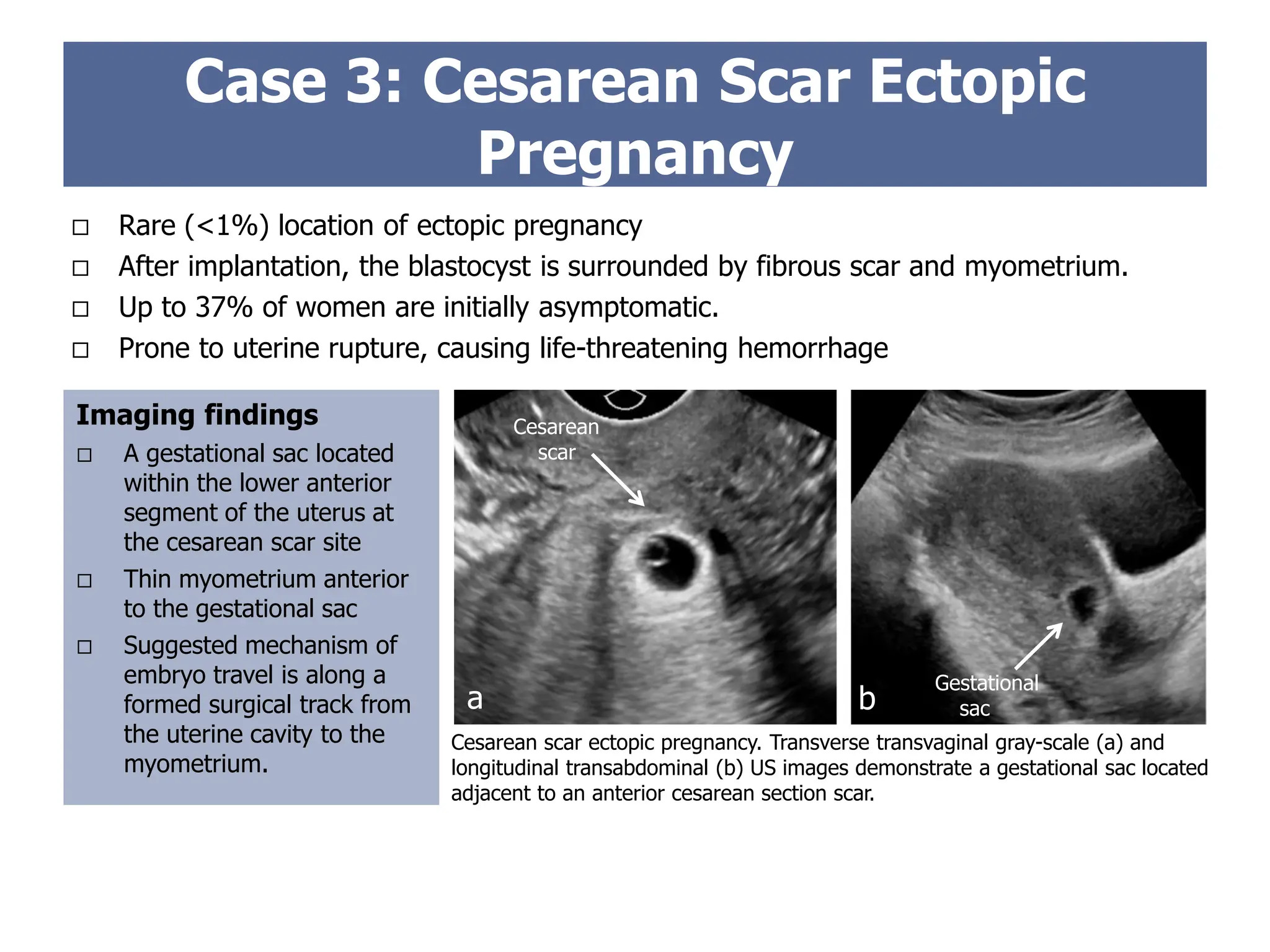 Rare (<1%) location of ectopic pregnancy
 After implantation, the blastocyst is surrounded by fibrous scar and myometrium.
 Up to 37% of women are initially asymptomatic.
 Prone to uterine rupture, causing life-threatening hemorrhage
Imaging findings
 A gestational sac located
within the lower anterior
segment of the uterus at
the cesarean scar site
 Thin myometrium anterior
to the gestational sac
 Suggested mechanism of
embryo travel is along a
formed surgical track from
the uterine cavity to the
myometrium.
Case 3: Cesarean Scar Ectopic
Pregnancy
Cesarean scar ectopic pregnancy. Transverse transvaginal gray-scale (a) and
longitudinal transabdominal (b) US images demonstrate a gestational sac located
adjacent to an anterior cesarean section scar.
Cesarean
scar
Gestational
sac
a b
 