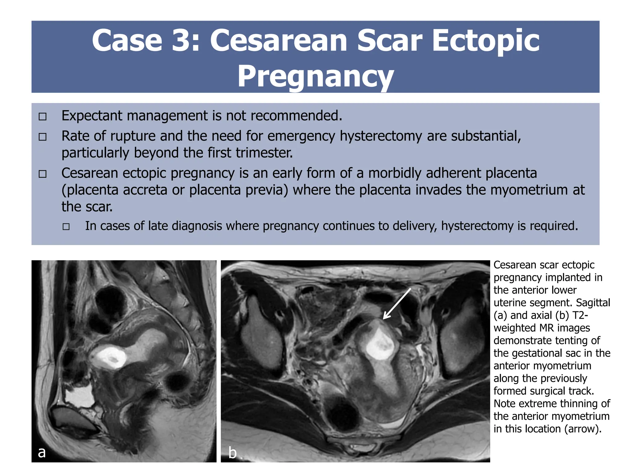  Expectant management is not recommended.
 Rate of rupture and the need for emergency hysterectomy are substantial,
particularly beyond the first trimester.
 Cesarean ectopic pregnancy is an early form of a morbidly adherent placenta
(placenta accreta or placenta previa) where the placenta invades the myometrium at
the scar.
 In cases of late diagnosis where pregnancy continues to delivery, hysterectomy is required.
Case 3: Cesarean Scar Ectopic
Pregnancy
Cesarean scar ectopic
pregnancy implanted in
the anterior lower
uterine segment. Sagittal
(a) and axial (b) T2-
weighted MR images
demonstrate tenting of
the gestational sac in the
anterior myometrium
along the previously
formed surgical track.
Note extreme thinning of
the anterior myometrium
in this location (arrow).
a b
 