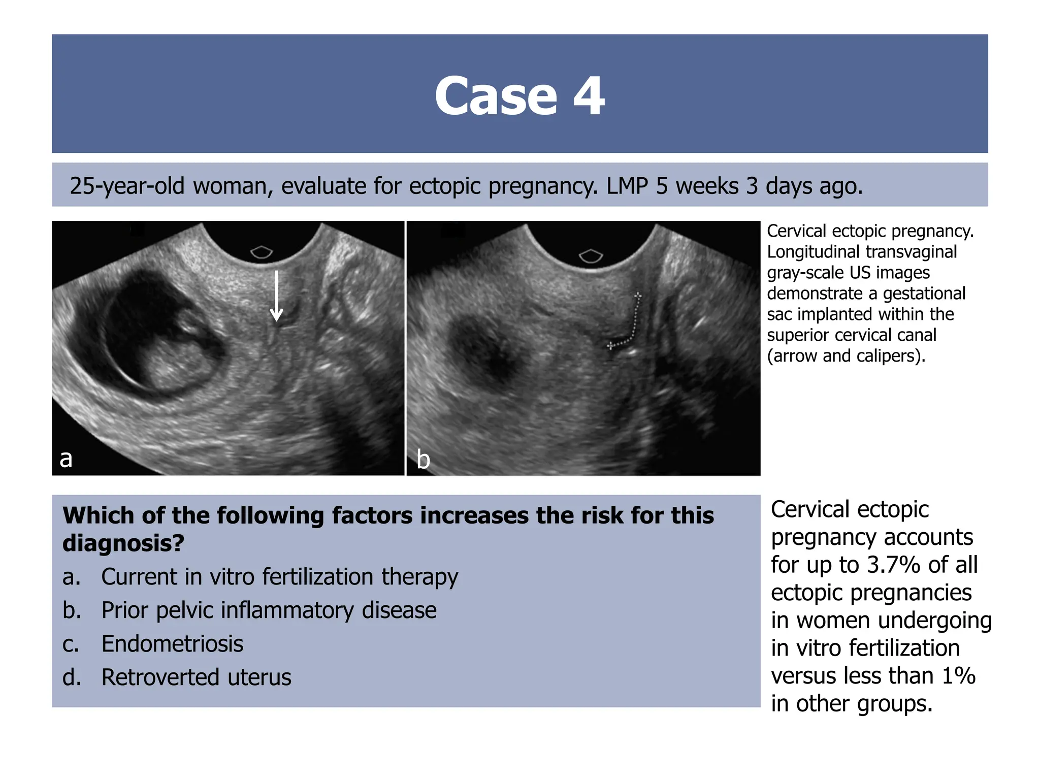 Case 4
25-year-old woman, evaluate for ectopic pregnancy. LMP 5 weeks 3 days ago.
Cervical ectopic pregnancy.
Longitudinal transvaginal
gray-scale US images
demonstrate a gestational
sac implanted within the
superior cervical canal
(arrow and calipers).
Which of the following factors increases the risk for this
diagnosis?
a. Current in vitro fertilization therapy
b. Prior pelvic inflammatory disease
c. Endometriosis
d. Retroverted uterus
Cervical ectopic
pregnancy accounts
for up to 3.7% of all
ectopic pregnancies
in women undergoing
in vitro fertilization
versus less than 1%
in other groups.
a b
 