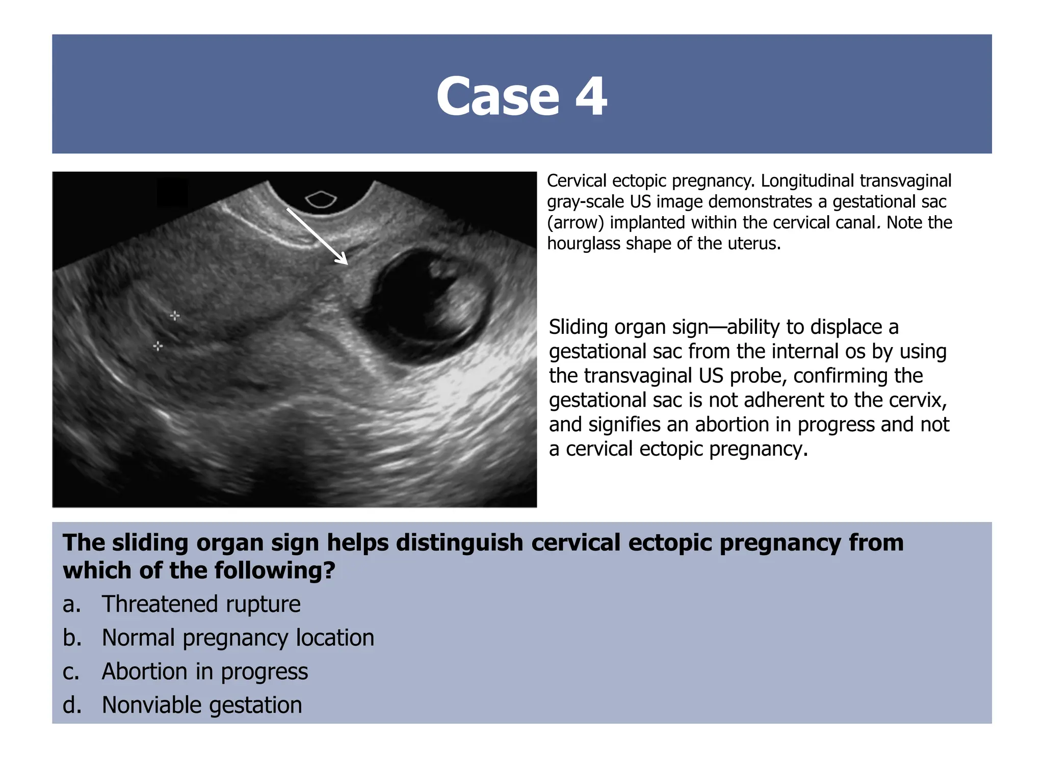 Case 4
Cervical ectopic pregnancy. Longitudinal transvaginal
gray-scale US image demonstrates a gestational sac
(arrow) implanted within the cervical canal. Note the
hourglass shape of the uterus.
The sliding organ sign helps distinguish cervical ectopic pregnancy from
which of the following?
a. Threatened rupture
b. Normal pregnancy location
c. Abortion in progress
d. Nonviable gestation
Sliding organ sign—ability to displace a
gestational sac from the internal os by using
the transvaginal US probe, confirming the
gestational sac is not adherent to the cervix,
and signifies an abortion in progress and not
a cervical ectopic pregnancy.
 