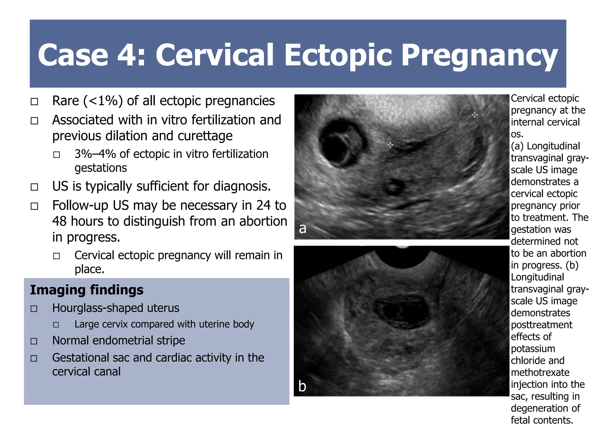  Rare (<1%) of all ectopic pregnancies
 Associated with in vitro fertilization and
previous dilation and curettage
 3%–4% of ectopic in vitro fertilization
gestations
 US is typically sufficient for diagnosis.
 Follow-up US may be necessary in 24 to
48 hours to distinguish from an abortion
in progress.
 Cervical ectopic pregnancy will remain in
place.
Imaging findings
 Hourglass-shaped uterus
 Large cervix compared with uterine body
 Normal endometrial stripe
 Gestational sac and cardiac activity in the
cervical canal
Case 4: Cervical Ectopic Pregnancy
Cervical ectopic
pregnancy at the
internal cervical
os.
(a) Longitudinal
transvaginal gray-
scale US image
demonstrates a
cervical ectopic
pregnancy prior
to treatment. The
gestation was
determined not
to be an abortion
in progress. (b)
Longitudinal
transvaginal gray-
scale US image
demonstrates
posttreatment
effects of
potassium
chloride and
methotrexate
injection into the
sac, resulting in
degeneration of
fetal contents.
A
B
a
b
 