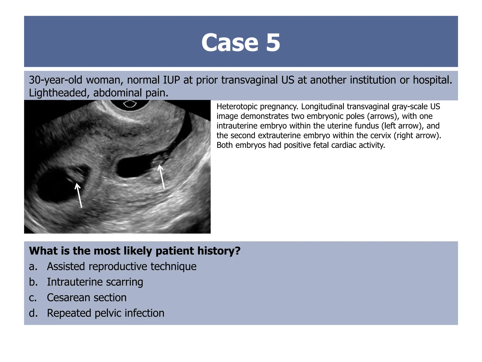 Case 5
30-year-old woman, normal IUP at prior transvaginal US at another institution or hospital.
Lightheaded, abdominal pain.
Heterotopic pregnancy. Longitudinal transvaginal gray-scale US
image demonstrates two embryonic poles (arrows), with one
intrauterine embryo within the uterine fundus (left arrow), and
the second extrauterine embryo within the cervix (right arrow).
Both embryos had positive fetal cardiac activity.
What is the most likely patient history?
a. Assisted reproductive technique
b. Intrauterine scarring
c. Cesarean section
d. Repeated pelvic infection
 
