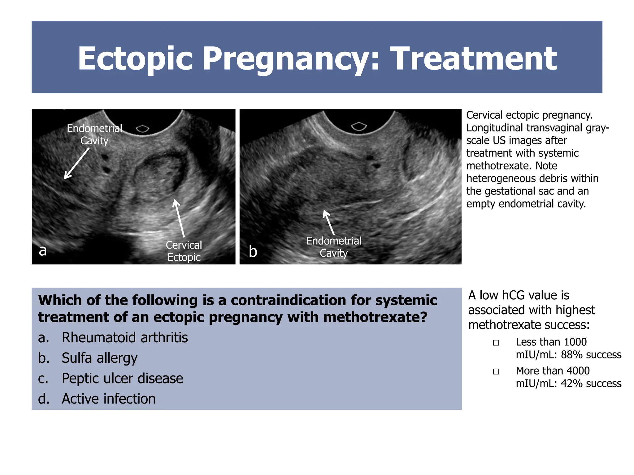 Endometrial
Cavity
Endometrial
Cavity
Cervical
Ectopic
Ectopic Pregnancy: Treatment
Which of the following is a contraindication for systemic
treatment of an ectopic pregnancy with methotrexate?
a. Rheumatoid arthritis
b. Sulfa allergy
c. Peptic ulcer disease
d. Active infection
Cervical ectopic pregnancy.
Longitudinal transvaginal gray-
scale US images after
treatment with systemic
methotrexate. Note
heterogeneous debris within
the gestational sac and an
empty endometrial cavity.
a b
A low hCG value is
associated with highest
methotrexate success:
 Less than 1000
mIU/mL: 88% success
 More than 4000
mIU/mL: 42% success
 
