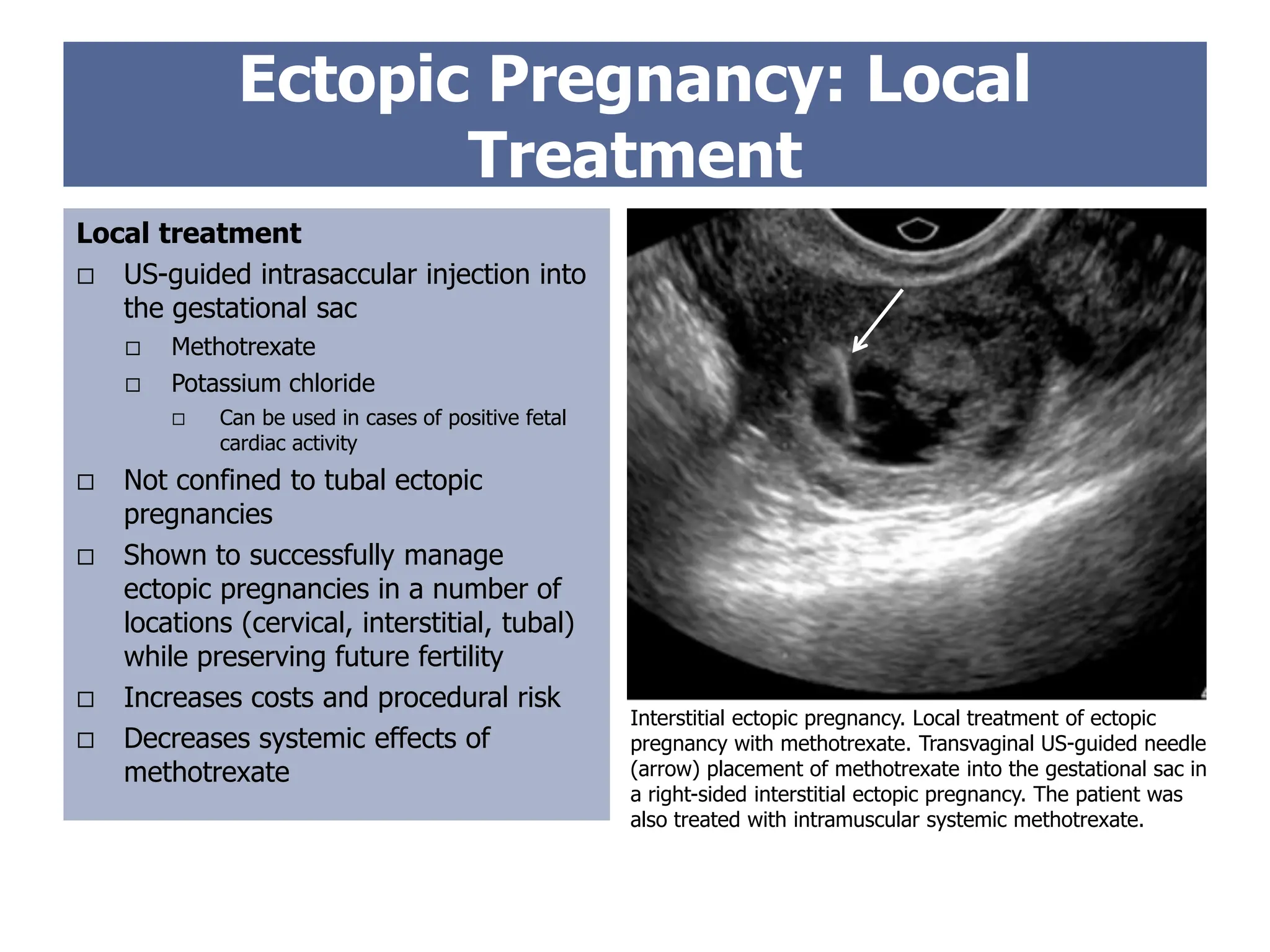 Ectopic Pregnancy: Local
Treatment
Interstitial ectopic pregnancy. Local treatment of ectopic
pregnancy with methotrexate. Transvaginal US-guided needle
(arrow) placement of methotrexate into the gestational sac in
a right-sided interstitial ectopic pregnancy. The patient was
also treated with intramuscular systemic methotrexate.
Local treatment
 US-guided intrasaccular injection into
the gestational sac
 Methotrexate
 Potassium chloride
 Can be used in cases of positive fetal
cardiac activity
 Not confined to tubal ectopic
pregnancies
 Shown to successfully manage
ectopic pregnancies in a number of
locations (cervical, interstitial, tubal)
while preserving future fertility
 Increases costs and procedural risk
 Decreases systemic effects of
methotrexate
 