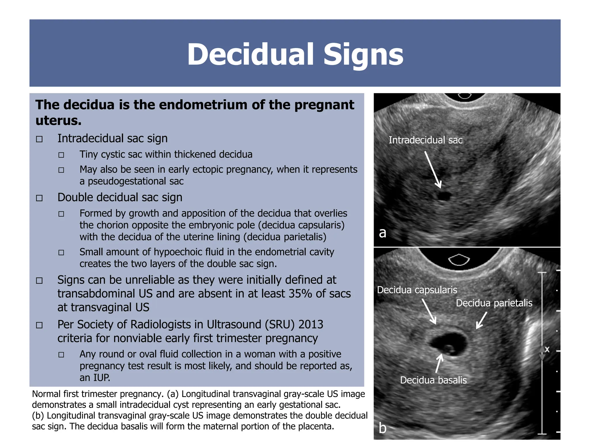 The decidua is the endometrium of the pregnant
uterus.
 Intradecidual sac sign
 Tiny cystic sac within thickened decidua
 May also be seen in early ectopic pregnancy, when it represents
a pseudogestational sac
 Double decidual sac sign
 Formed by growth and apposition of the decidua that overlies
the chorion opposite the embryonic pole (decidua capsularis)
with the decidua of the uterine lining (decidua parietalis)
 Small amount of hypoechoic fluid in the endometrial cavity
creates the two layers of the double sac sign.
 Signs can be unreliable as they were initially defined at
transabdominal US and are absent in at least 35% of sacs
at transvaginal US
 Per Society of Radiologists in Ultrasound (SRU) 2013
criteria for nonviable early first trimester pregnancy
 Any round or oval fluid collection in a woman with a positive
pregnancy test result is most likely, and should be reported as,
an IUP.
Normal first trimester pregnancy. (a) Longitudinal transvaginal gray-scale US image
demonstrates a small intradecidual cyst representing an early gestational sac.
(b) Longitudinal transvaginal gray-scale US image demonstrates the double decidual
sac sign. The decidua basalis will form the maternal portion of the placenta.
a
Intradecidual sac
Decidual Signs
b
Decidua basalis
Decidua capsularis
Decidua parietalis
 