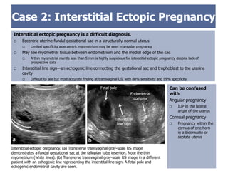 Ectopic Pregnancy: A trainee's guide to making the right call. | PDF