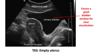 ECTOPIC PREGNANCY | PPTX
