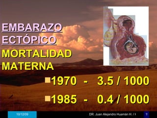 EMBARAZO ECTÓPICO 1970  -  3.5 / 1000 1985  -  0.4 / 1000 MORTALIDAD MATERNA 