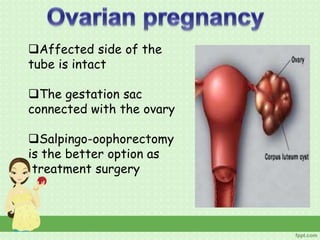 Affected side of the
tube is intact
The gestation sac
connected with the ovary
Salpingo-oophorectomy
is the better option as
treatment surgery
 