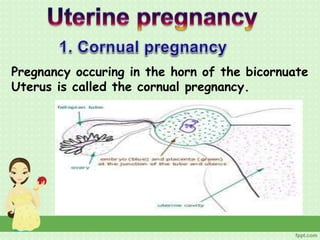 Pregnancy occuring in the horn of the bicornuate
Uterus is called the cornual pregnancy.
 
