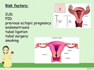 Risk factors:
IUD
PID
previous ectopic pregnancy
endometriosis
tubal ligation
tubal surgery
smoking
…
 