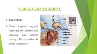 SURGICAL MANAGEMENT
 Laparotomy
 Many surgeons suggest
removing the embryo and
repairing any internal
damage. This procedure is
called laparotomy.
 