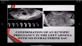 ectopic pregnancy types and radiology us findings | PPT