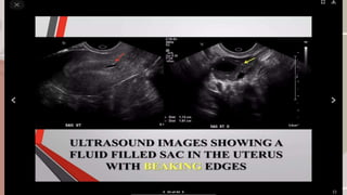 ectopic pregnancy types and radiology us findings | PPT