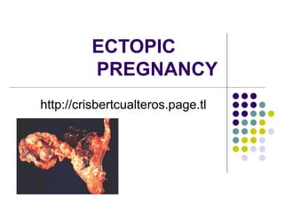 ECTOPIC  PREGNANCY http://crisbertcualteros.page.tl 