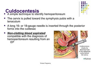 Culdocentesis A simple technique to identify hemoperitoneum The cervix is pulled toward the symphysis pubis with a tenaculum A long 16- or 18-gauge needle is inserted through the posterior fornix into the culdesac Non-clotting blood aspirated :  compatible with the diagnosis of  hemoperitoneum resulting from an  EP 