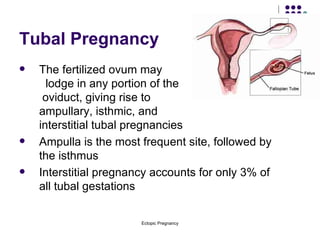 Tubal Pregnancy The fertilized ovum may  lodge in any portion of the  oviduct, giving rise to  ampullary, isthmic, and  interstitial tubal pregnancies Ampulla is the most frequent site, followed by the isthmus Interstitial pregnancy accounts for only 3% of all tubal gestations 