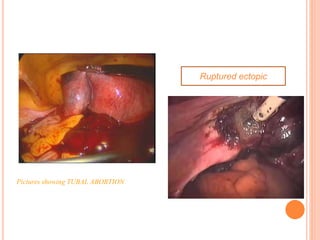 Pictures showing TUBAL ABORTION
Ruptured ectopic
 