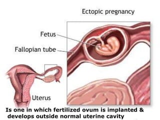 Is one in which fertilized ovum is implanted &
develops outside normal uterine cavity
 