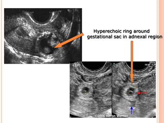 Hyperechoic ring around
gestational sac in adnexal region
 