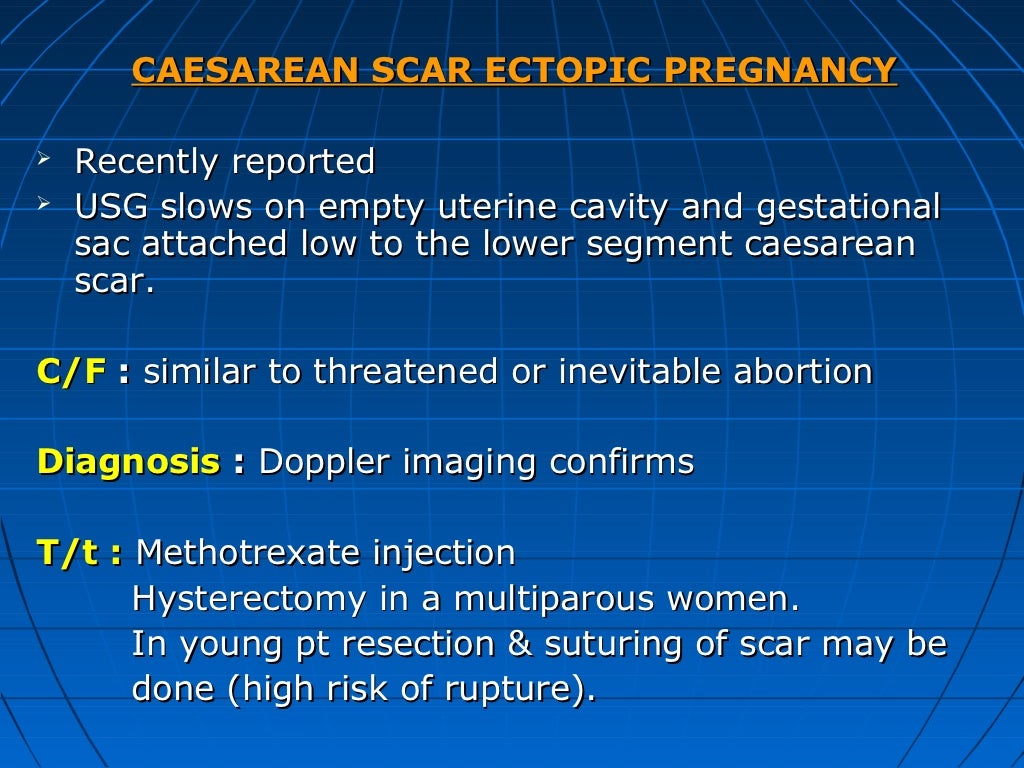 Ectopic pregnancy