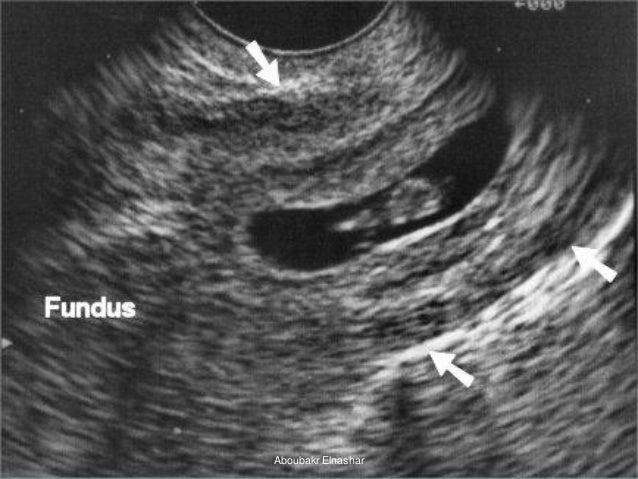 На узи видно внематочную. Внематочная беременность на УЗИ. Внематочная беременность на УЗИ фото. УЗИ внематочной беременности 5 недель.