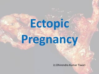 Ectopic
Pregnancy
Lt.Dhirendra Kumar Tiwari
 