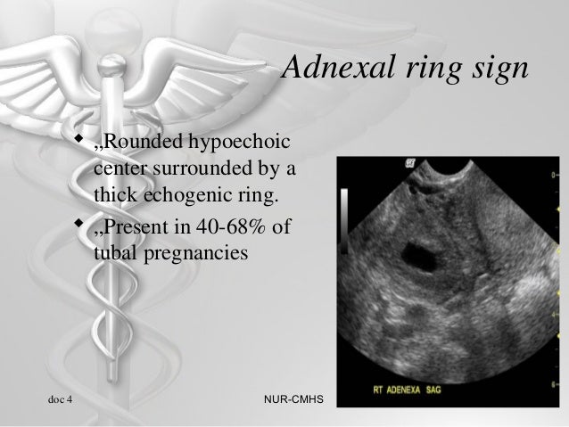 Ectopic pregnancy.presentation pascal m