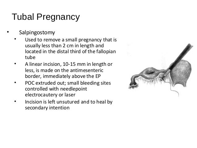 Tubal Pregnancy Tubal Pregnancy