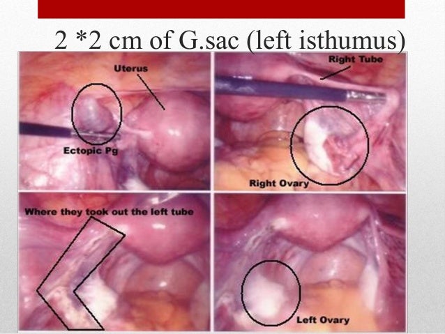 2 2 Cm Of G Sac Left Isthumus 9 Ectopic Pregnancyectopic Pregnancy 2 2 Cm Of G Sac Left Isthumus 9 Ectopic Pregnancyectopic Pregnancy