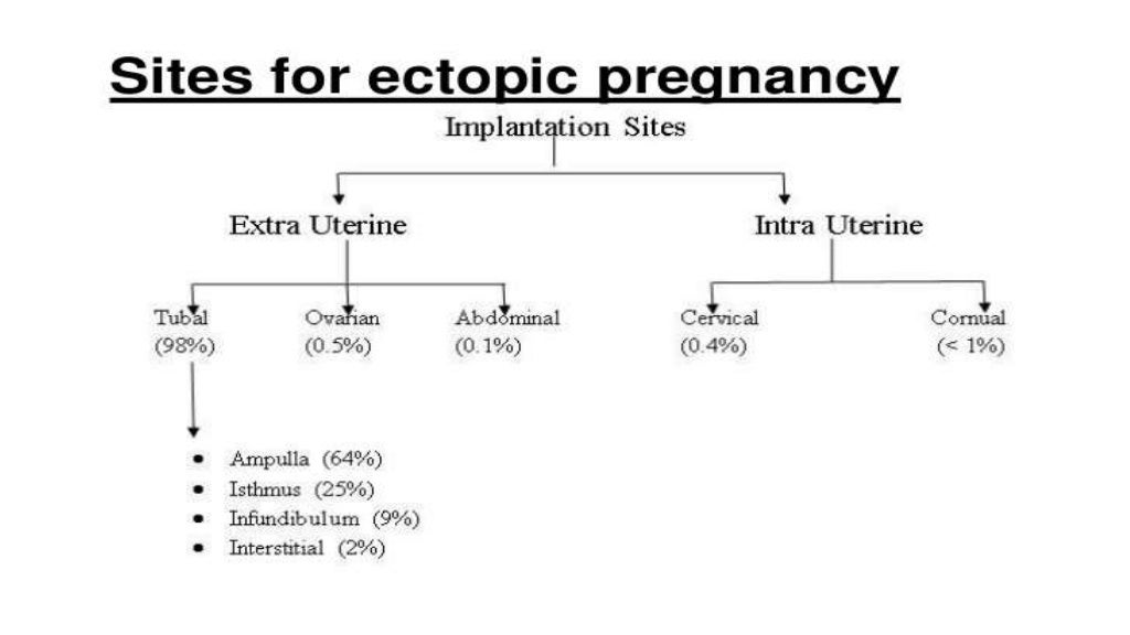 Ectopic pregnancy