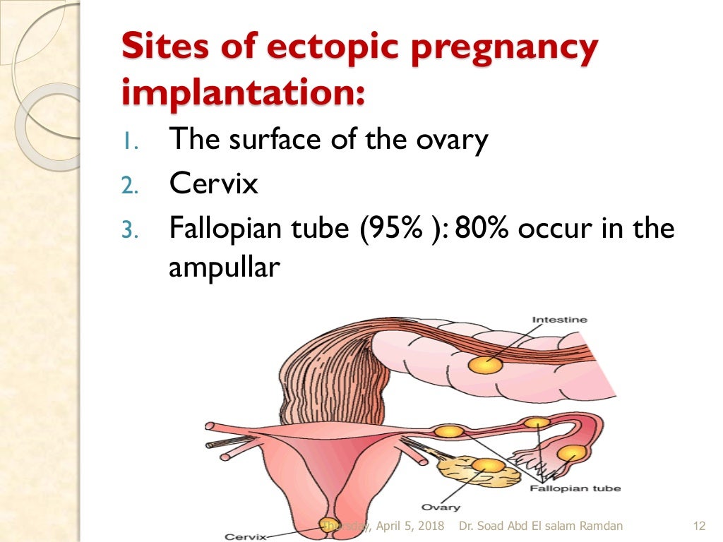 Ectopic pregnancy